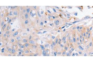 Immunohistochemistry of paraffin-embedded Human cervical cancer using KCNA1 Polyclonal Antibody at dilution of 1:30