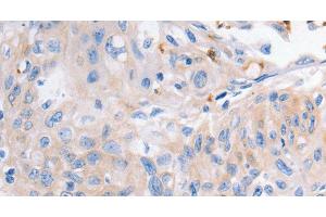 Immunohistochemistry of paraffin-embedded Human cervical cancer using KCNA1 Polyclonal Antibody at dilution of 1:30 (KCNA1 Antikörper)