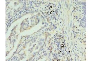 Immunohistochemistry of paraffin-embedded human lung cancer using ABIN7170235 at dilution of 1:100 (SLC35F5 Antikörper  (AA 122-242))