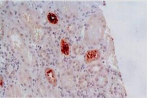 Immunohistochemistry staining of kidney allograft biopsy (paraffin-embedded sections) with anti-human HLA-G (MEM-G/2). (HLAG Antikörper)