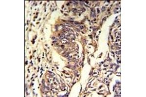 Formalin-fixed and paraffin-embedded human lung carcinoma reacted with KYNU Antibody (C-term), which was peroxidase-conjugated to the secondary antibody, followed by DAB staining. (KYNU Antikörper  (C-Term))