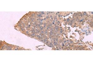 Immunohistochemistry of paraffin-embedded Human liver cancer tissue using KCNU1 Polyclonal Antibody at dilution of 1:45(x200) (KCNU1 Antikörper)