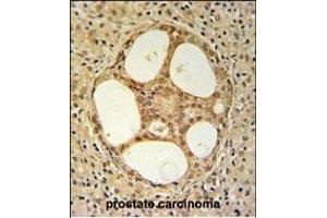 PRUNE Antibody (C-term) (ABIN653704 and ABIN2843021) IHC analysis in formalin fixed and paraffin embedded prostate carcinoma followed by peroxidase conjugation of the secondary antibody and DAB staining. (PRUNE Antikörper  (C-Term))