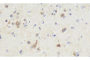 Immunohistochemistry analysis of paraffin-embedded Human brain cancer using NOS1 Polyclonal Antibody at dilution of 1:300. (NOS1 Antikörper)