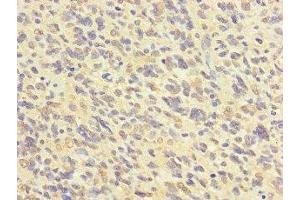 Immunohistochemistry of paraffin-embedded human glioma using ABIN7152623 at dilution of 1:100 (FABP7 Antikörper  (AA 2-132))