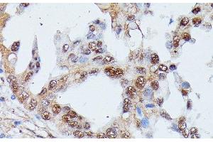 Immunohistochemistry of paraffin-embedded Human lung cancer using IGHMBP2 Polyclonal Antibody at dilution of 1:100 (40x lens). (IGHMBP2 Antikörper)