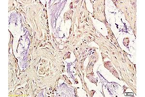 Formalin-fixed and paraffin embedded human colorectal cancer labeled with Anti-oxLDL Polyclonal Antibody, Unconjugated (ABIN733148) followed by conjugation to the secondary antibody and DAB staining (OxLDL Antikörper)