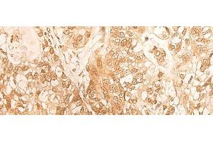 Immunohistochemistry of paraffin-embedded Human gastric cancer tissue using DBP Polyclonal Antibody at dilution of 1:25(x200) (DBP Antikörper)