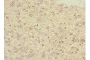 Immunohistochemistry of paraffin-embedded human glioma using ABIN7166554 at dilution of 1:100 (Protocadherin 1 Antikörper  (AA 515-715))