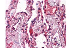 Immunohistochemistry (IHC) image for anti-Cadherin 1, Type 1, E-Cadherin (Epithelial) (CDH1) (AA 381-481) antibody (ABIN574222)