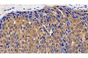 Detection of CTSK in Human Breast cancer Tissue using Polyclonal Antibody to Cathepsin K (CTSK) (Cathepsin K Antikörper  (AA 54-317))