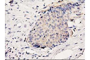 Immunohistochemical staining of paraffin-embedded Adenocarcinoma of Human breast tissue using anti-BCAR1 mouse monoclonal antibody. (BCAR1 Antikörper)