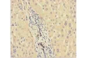 Immunohistochemistry of paraffin-embedded human liver cancer using ABIN7165631 at dilution of 1:100 (C11orf73 Antikörper  (AA 1-197))
