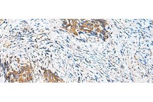 Immunohistochemistry of paraffin-embedded Human cervical cancer tissue using CAMSAP3 Polyclonal Antibody at dilution of 1:110(x200) (CAMSAP3 Antikörper)