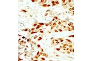 Formalin-fixed and paraffin-embedded human cancer tissue (breast carcinoma) reacted with the primary antibody, which was peroxidase-conjugated to the secondary antibody, followed by DAB staining. (DAPK2 Antikörper  (N-Term))