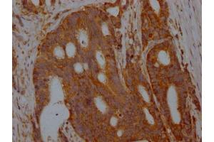 IHC image of ABIN7127334 diluted at 1:100 and staining in paraffin-embedded human colon cancer performed on a Leica BondTM system. (Rekombinanter ALDOA Antikörper)