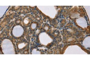 Immunohistochemistry of paraffin-embedded Human thyroid cancer using SCGB2A1 Polyclonal Antibody at dilution of 1:50 (SCGB2A1 Antikörper)