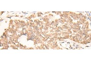 Immunohistochemistry of paraffin-embedded Human lung cancer tissue using EMSY Polyclonal Antibody at dilution of 1:25(x200)