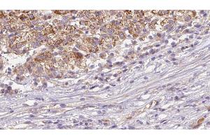 ABIN6272645 at 1/100 staining Human liver cancer tissue by IHC-P. (CD235a/GYPA Antikörper  (Internal Region))