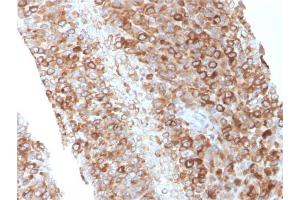 Formalin-fixed, paraffin-embedded human Melanoma stained with CD63 Mouse Monoclonal Antibody (LAMP3/2881) (CD63 Antikörper  (AA 100-197))