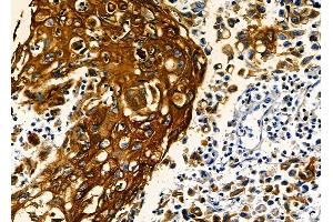 ABIN6262729 and ABIN6278925 at 1/100 staining human esophageal cancer by IHC-P. (Keratin 6 Antikörper  (C-Term))