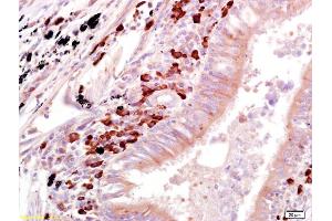 Formalin-fixed and paraffin embedded human lung carcinoma labeled with Anti-OAS1 Polyclonal Antibody, Unconjugated (ABIN671931) at 1:200 followed by conjugation to the secondary antibody and DAB staining (OAS1 Antikörper)