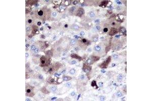 Immunohistochemical analysis of PSMD8 staining in human liver cancer formalin fixed paraffin embedded tissue section.