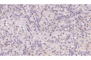 ABIN6273121 at 1/100 staining Human lymph cancer tissue by IHC-P. (Hemoglobin, epsilon 1 (HBe1) Antikörper)