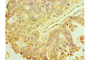 Immunohistochemistry of paraffin-embedded human endometrial cancer using ABIN7150706 at dilution of 1:100 (MAP2K3 Antikörper  (AA 1-170))