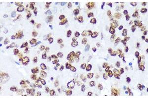 Immunohistochemistry of paraffin-embedded Human liver cancer using Phospho-ABL1(Y245) Polyclonal Antibody at dilution of 1:100 (40x lens). (ABL1 Antikörper  (pTyr245))