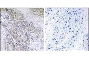 Immunohistochemistry analysis of paraffin-embedded human breast carcinoma, using BCL-2 (Phospho-Thr56) Antibody. (Bcl-2 Antikörper  (pThr56))