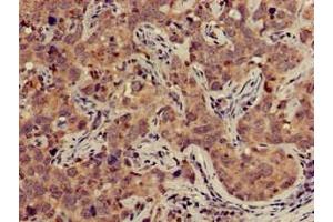 Immunohistochemistry of paraffin-embedded human pancreatic cancer using ABIN7149950 at dilution of 1:100 (TFB2M Antikörper  (AA 30-108))