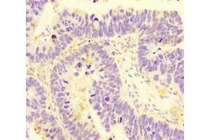 Immunohistochemistry of paraffin-embedded human ovarian cancer using ABIN7170745 at dilution of 1:100 (SAMD7 Antikörper  (AA 1-300))