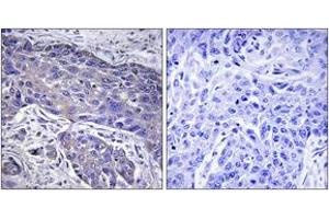 Immunohistochemistry analysis of paraffin-embedded human lung carcinoma tissue, using POFUT1 Antibody.