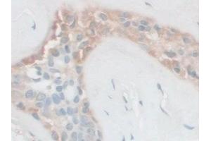 Detection of FSTL1 in Human Breast cancer Tissue using Polyclonal Antibody to Follistatin Like Protein 1 (FSTL1) (FSTL1 Antikörper  (AA 21-308))