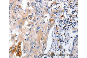 Immunohistochemistry of Human cervical cancer using IL18 Polyclonal Antibody at dilution of 1:100 (IL-18 Antikörper)