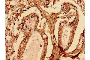 Immunohistochemistry analysis of human pancreatic cancer using ABIN7145580 at dilution of 1:100 (Biglycan Antikörper  (AA 38-300))