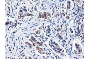 Immunohistochemical staining of paraffin-embedded Carcinoma of Human lung tissue using anti-HARS2 mouse monoclonal antibody. (HARS2 Antikörper)