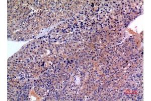 Immunohistochemistry (IHC) analysis of paraffin-embedded Human Liver Cancer, antibody was diluted at 1:100. (SCCA1/2 (Internal Region) Antikörper)