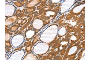 The image on the left is immunohistochemistry of paraffin-embedded Human thyroid cancer tissue using ABIN7131182(SRGAP3 Antibody) at dilution 1/40, on the right is treated with fusion protein. (SRGAP3 Antikörper)