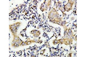 IHC-P: Caspase-8 antibody testing of human breast cancer tissue (Caspase 8 Antikörper  (AA 458-473))