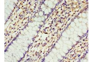 Immunohistochemistry of paraffin-embedded human colon cancer using ABIN7168957 at dilution of 1:100 (STRAP Antikörper  (AA 1-350))