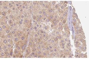 ABIN6277408 at 1/100 staining Human Melanoma tissue by IHC-P. (MMP11 Antikörper  (N-Term))