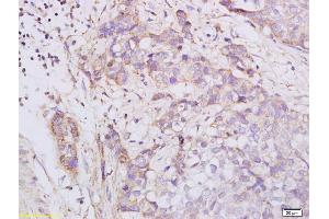 Formalin-fixed and paraffin embedded human esophageal carcinoma labeled with Anti phospho-PKA R2 (Ser96) Polyclonal Antibody, Unconjugated (ABIN752668) at 1:200 followed by conjugation to the secondary antibody and DAB staining (PRKAR2A Antikörper  (pSer96))