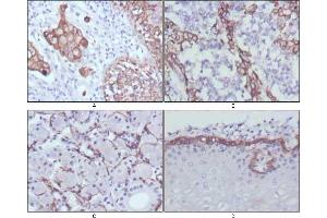 Immunohistochemical analysis of paraffin-embedded human lung cancer (A), endometrial carcinoma (B), sublingual gland (C) and esophagus (D) tissues using CK17 mouse mAb with DAB staining.