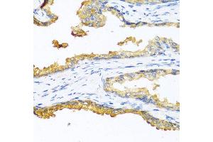 Immunohistochemistry of paraffin-embedded human prostate cancer using CPB2 antibody at dilution of 1:100 (40x lens).