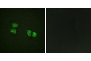 P-peptide - +Immunohistochemistry analysis of paraffin-embedded human breast carcinoma tissue using DDX5/DEAD-box Protein 5 (Phospho-Tyr593) antibody. (DDX5 Antikörper  (pTyr593))