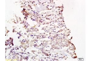 Formalin-fixed and paraffin embedded human breast carcinoma labeled with Rabbit Anti Phospho-MEK1/2(Ser218/222) Polyclonal Antibody, Unconjugated (ABIN743813) at 1:200 followed by conjugation to the secondary antibody and DAB staining (MEK1/2 Antikörper  (pSer218, pSer222))