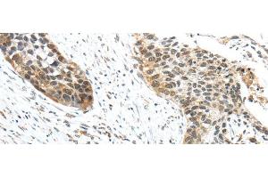 Immunohistochemistry of paraffin-embedded Human esophagus cancer tissue using TRIP6 Polyclonal Antibody at dilution 1:50 (TRIP6 Antikörper)