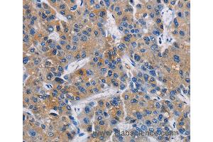Immunohistochemistry of Human liver cancer using GPM6A Polyclonal Antibody at dilution of 1:40 (GPM6A Antikörper)